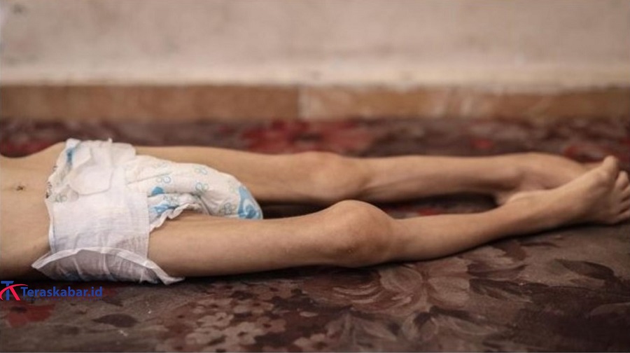 Lima Warga Gaza Meninggal Kelaparan, Korban Tembus 193 Jiwa