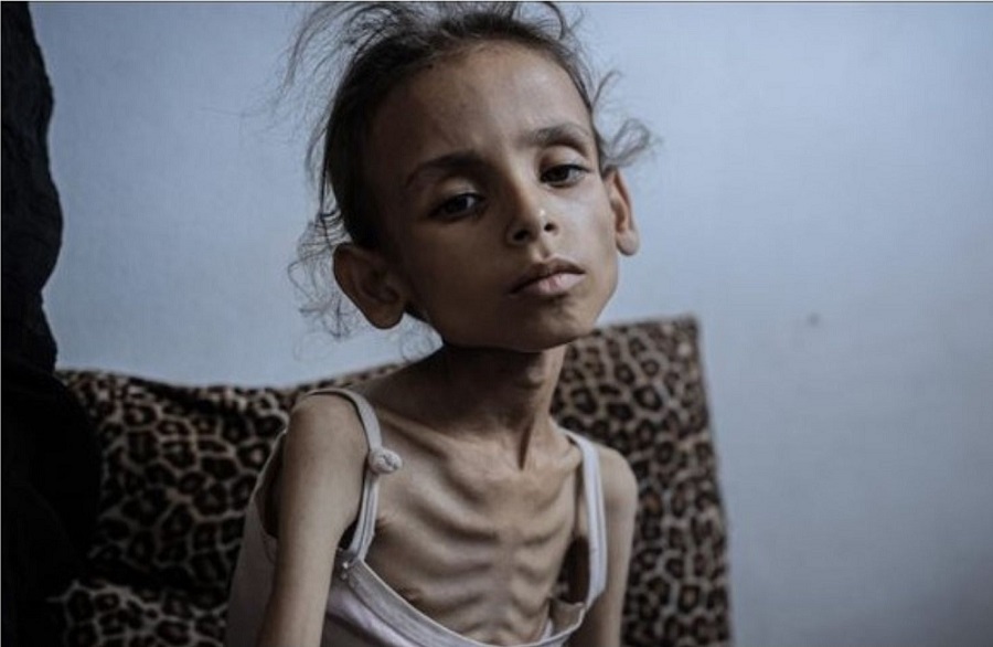 Tujuh Warga Gaza Tewas karena Kelaparan dan Malnutrisi, Total Korban Jadi 169 Orang